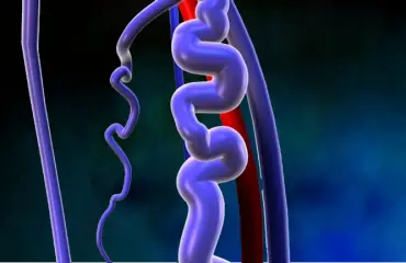 Varicose Veins