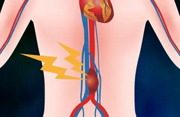 Anuerysm Diagram